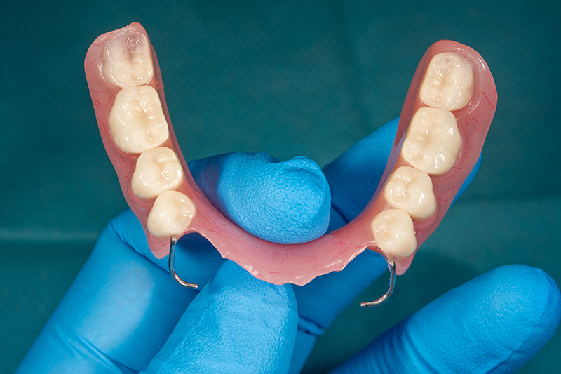 Partial denture appliance shown on a clean clinical background