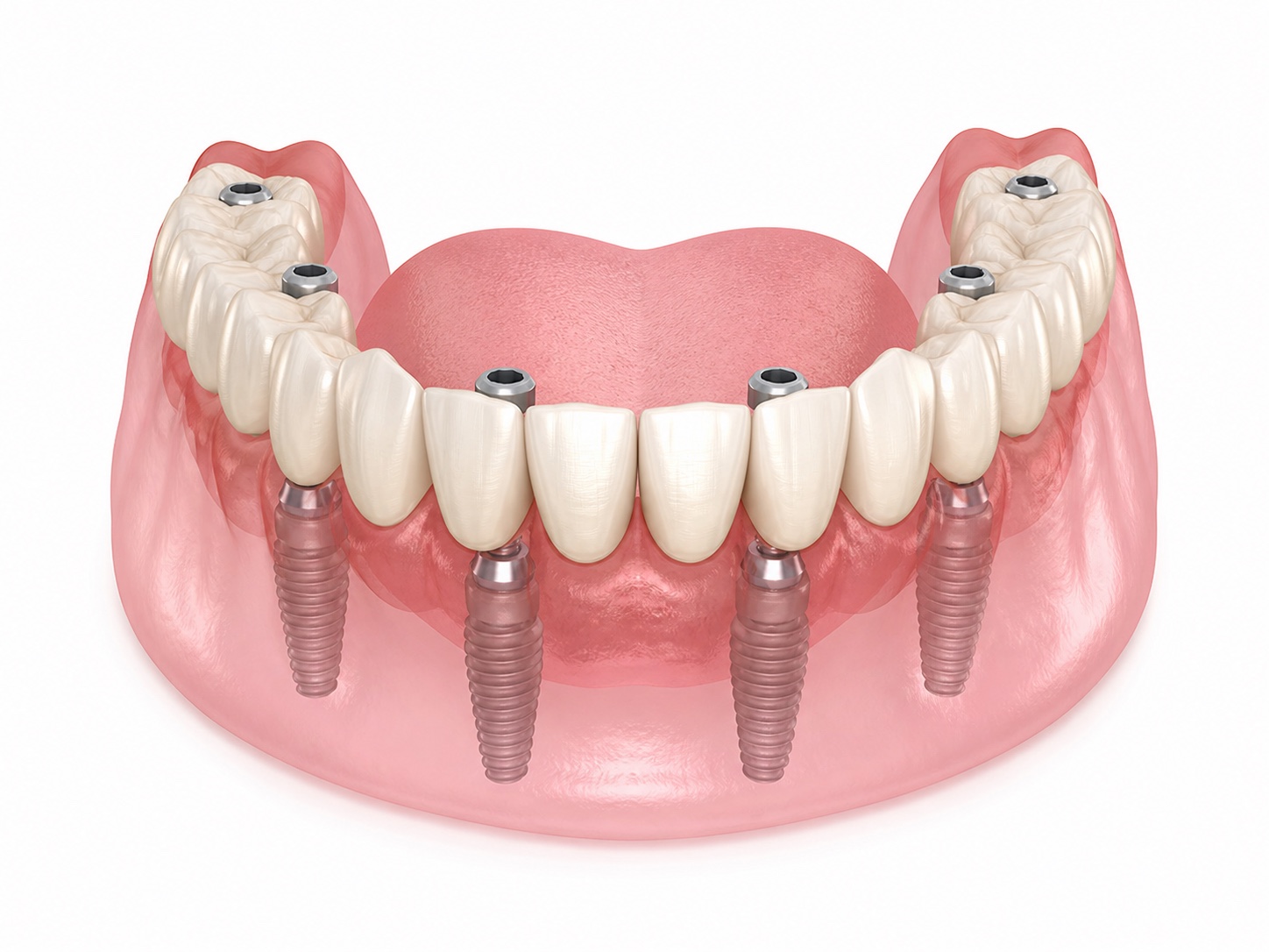 All-on-6 full-arch bridge supported by six implant posts