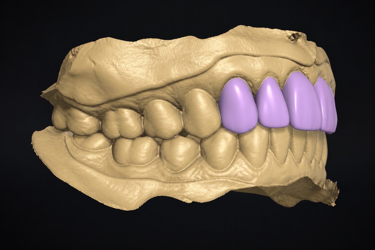 Digital scan and CAD design of a custom denture