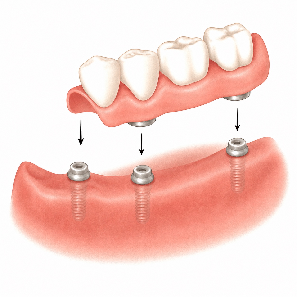 Implant-retained partial denture aligning with three locator attachments