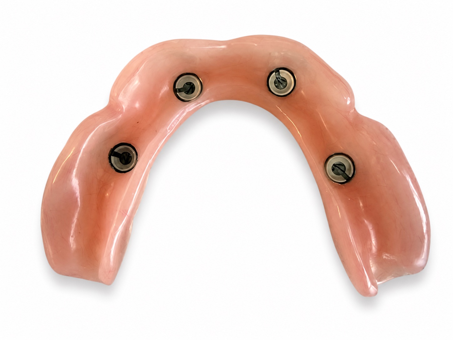 MyBite locator overdenture showing four metal housings