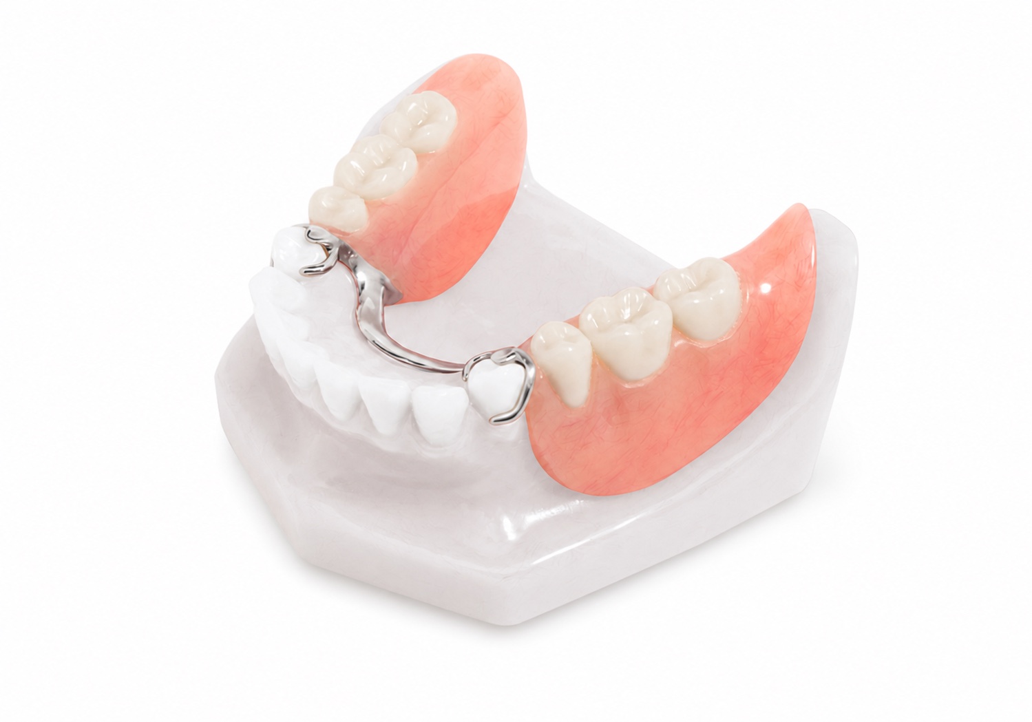 Removable partial denture with a metal framework on a dental model