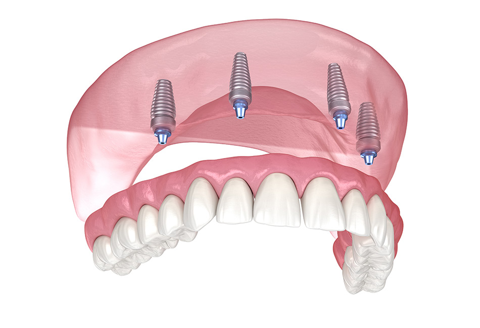 All-on-4 prosthetic preserves jawbone
